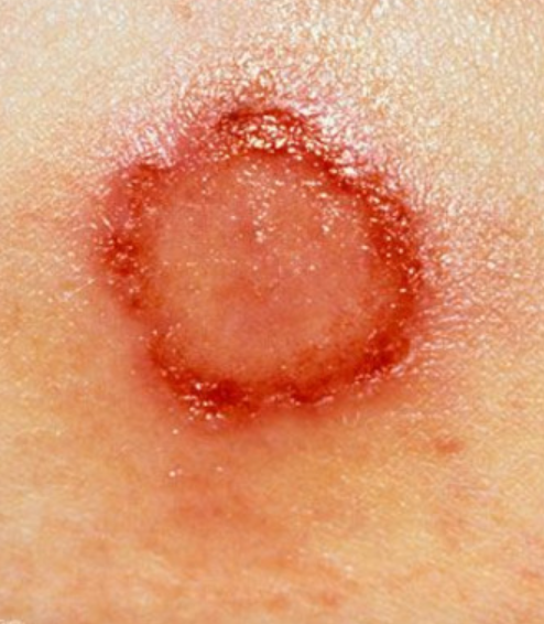 빈대(베드 버그), 벼룩, 모기, 진드기, 좀벌레, 집게벌레, 개미, 거미, 벌, 이 : 무는 벌레 10종 총정리 + 퇴치방법