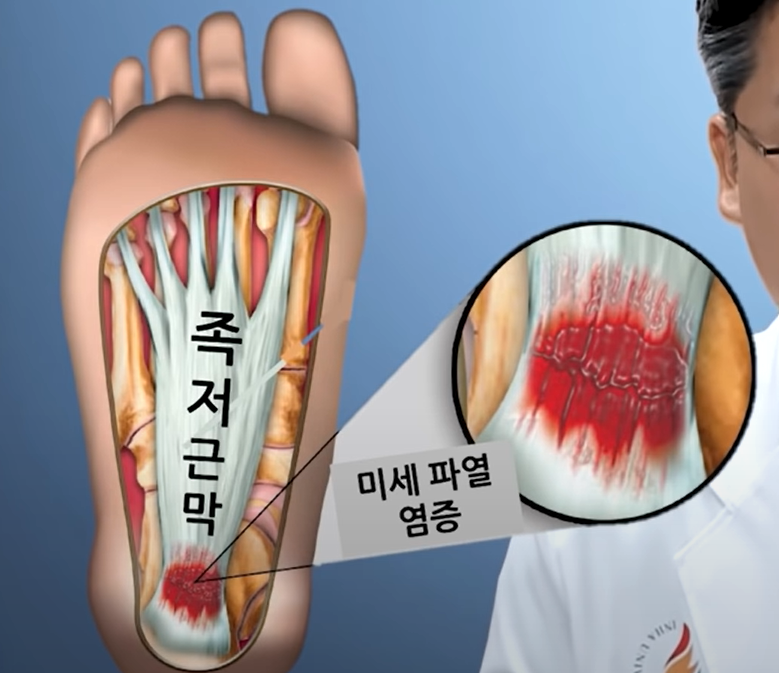 족저근막염: 발 통증 원인, 예방법, 나쁜 자세, 치료 및 스트레칭 방법 4 족저근막염: 원인, 예방법, 나쁜 자세, 치료 및 스트레칭 방법