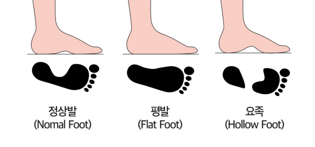족저근막염: 발 통증 원인, 예방법, 나쁜 자세, 치료 및 스트레칭 방법 8 족저근막염: 원인, 예방법, 나쁜 자세, 치료 및 스트레칭 방법
