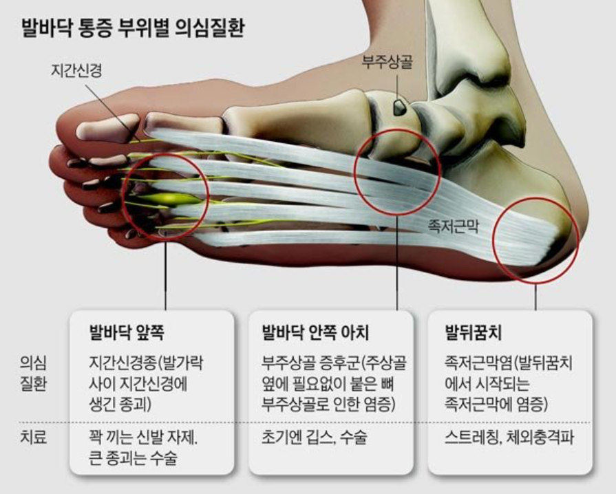 족저근막염: 발 통증 원인, 예방법, 나쁜 자세, 치료 및 스트레칭 방법 25 족저근막염: 원인, 예방법, 나쁜 자세, 치료 및 스트레칭 방법