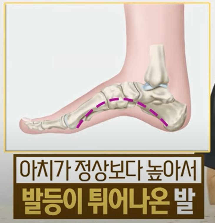 요족 : 발을 자주 삐는 이유(염좌/아치) 1 요족 : 발을 자주 삐는 이유