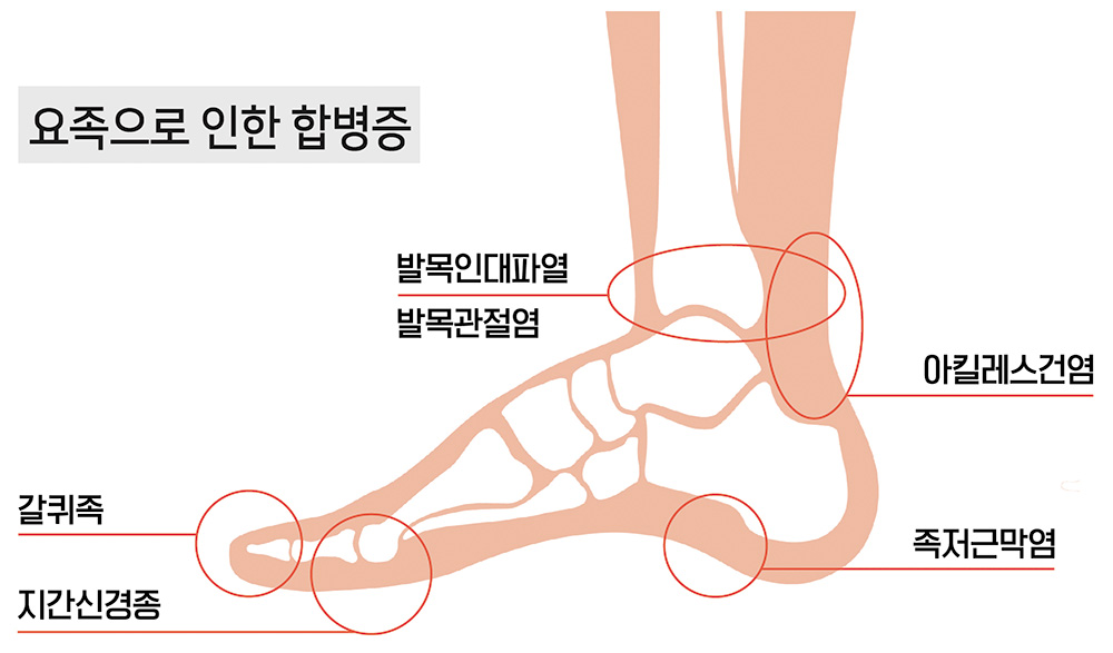 요족 : 발을 자주 삐는 이유(염좌/아치) 6 요족 : 발을 자주 삐는 이유