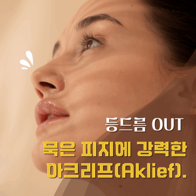 🥚여름철 등드름·몸드름·묵은 피지에 딱 – 아크리프(Aklief) 연고 솔직 사용 후기